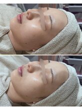 ソワナ(soina)/【神楽坂駅/フェイシャル/毛穴】