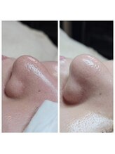 サロン ザ プマロ(SalonThePumalo)/毛穴エクストラクション