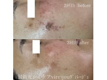 シミケアコース／レモンボトルのメニュー