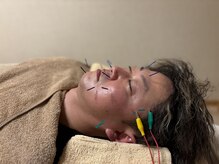 イロドリ 南森町(irodori)の雰囲気(【美容鍼灸】男性にも大人気の顔鍼。仕事効率up、眼精疲労軽減)