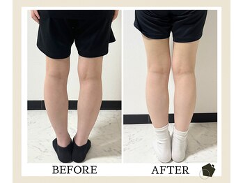 サンク(Cinq)/O脚矯正と骨盤矯正にて歪み改善
