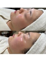 サロンドシェフィア(Salon de Chefia)/20代後半女性 症例写真