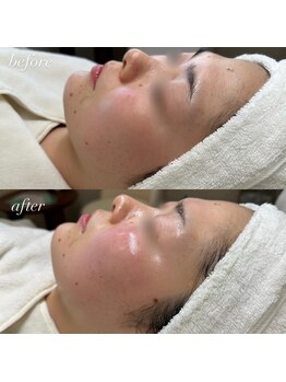 サロンドシェフィア(Salon de Chefia)/20代後半女性 症例写真