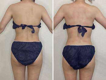 カプリス(CAPRiCE)/リンパドレナージュ