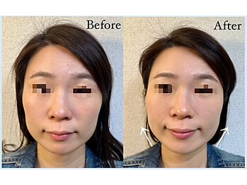 エリシオン(ELYSION)/小顔マッサージ