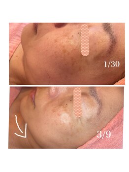 ヒメミ(Himemi)/小顔BBL3回目