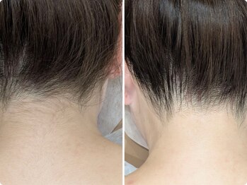 ワイスリー(Y3)/うなじ脱毛