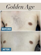 ゴールデンエイジ(Golden Age)/【全身脱毛】Before＆After
