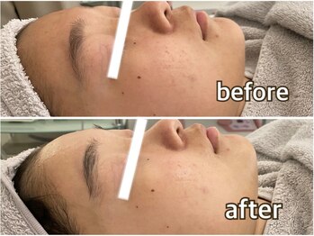 パーム(Palm)/エイジングお顔脱毛