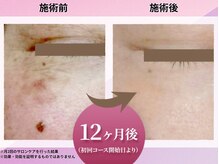 花蔵クール 金沢店/【コース開始12か月経過時点】