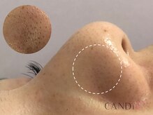 キャンディ 天王寺(CANDi)/ハイドラピーリング黒ずみ毛穴◎