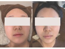 美成(vise)の雰囲気（レモンボトル4回施術です。※個人差はございます。）