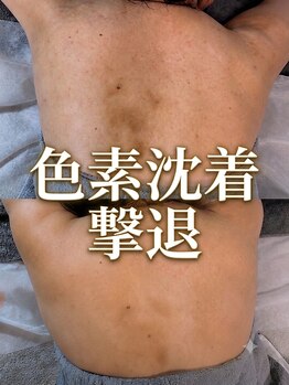 エレ(ele)/剥ける剥離有りハーブ◎背中
