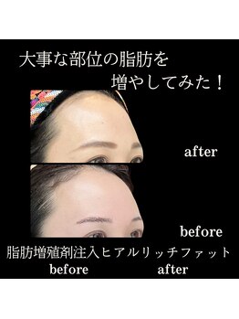 クリニカルボーテ 心斎橋院(CLINICAL BEAUTE)/まん丸なおでこが叶う！