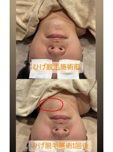 るあん/髭脱毛Before＆After