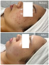 リアム(LiAm)/第4世代ララピール