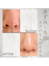 美バリ 新宿店(美BARI)/エアバリ×ハイドラ　3回