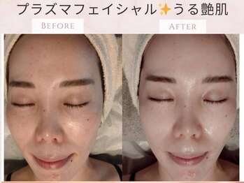 藍/プラズマで最短美肌