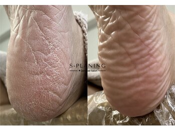 ロンディネ(Rondine)/韓国式足裏角質ケア50