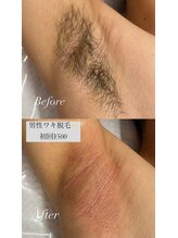 ルウム 東新宿店(lum)/脱毛lum/脇脱毛でスッキリ★