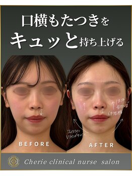 シェリー(Cherie)/口横のたるみともたつき