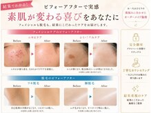 ルシェンテ 鈴鹿(Lucente)/フェイシャル、脱毛◆効果実感！