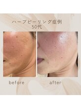リジュベネ(rejuvena)/ハーブピーリング症例　50代女性