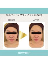 ニュウミー 諏訪本店(newme)/小顔　ビフォーアフター2