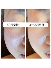 グラチア(Gratiae)/50代/老け顔改善プログラム