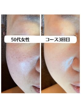 グラチア(Gratiae)/50代/老け顔改善プログラム