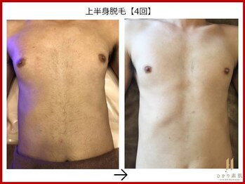 ひかり素肌/上半身脱毛4回