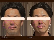 クレスト(CREST)/ビフォーアフター【小顔名古屋】