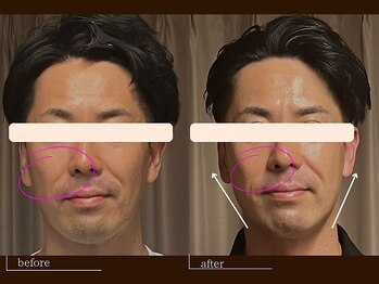 クレスト(CREST)/ビフォーアフター【小顔名古屋】