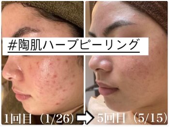 ベル みどりの店(belle)/あらゆる肌トラブルに