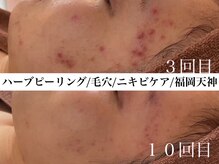 ホワイトアクア 福岡天神店(WHITE AQUA)/ハーブピーリングビフォー