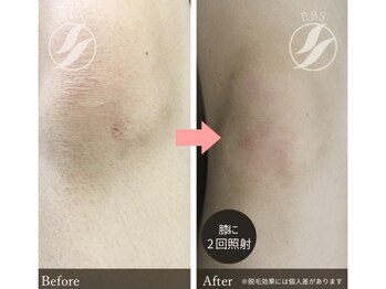 グリシーヌ(GLYCINE)/脱毛効果★