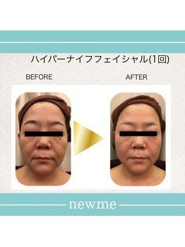 ニュウミー 諏訪本店(newme)/小顔　ビフォーアフター3