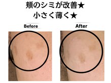 グレースティー 森町 箕面/頬のシミが改善◎小さく薄く★