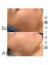 ナニワ ビューティー(naniwa beauty)/小顔WINBACK