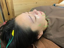 鍼灸施術や美容鍼も当院でご利用いただけます。