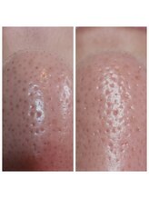 サロン ザ プマロ(SalonThePumalo)/根深い毛穴汚れ/毛穴ケア