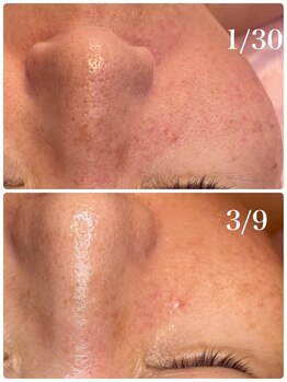 ヒメミ(Himemi)/頬の毛穴 BBL