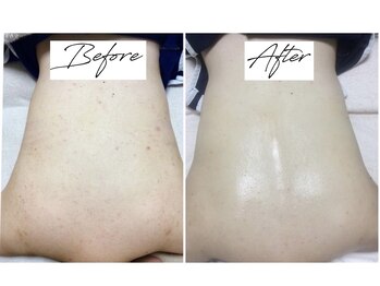 ビズビズ 梅田店(bisebise)/<症例>背中ニキビケア・跡