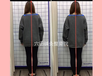 穴田鍼灸整骨院/整体・骨盤・ねこぜ・まき肩矯正