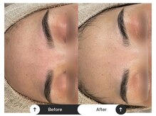 リジュ(Reje)/赤み&ニキビケア