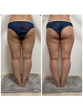 エステサロンブランシュ(Esthe salon Blanche)/ハイパーナイフ下半身痩せ