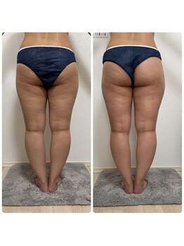 エステサロンブランシュ(Esthe salon Blanche)/ハイパーナイフ下半身痩せ