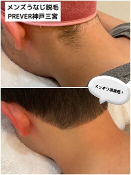 プレヴェール 神戸三宮/メンズうなじ脱毛