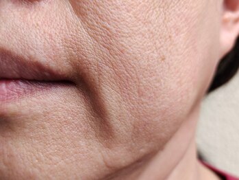 サンティエ(Santie)の写真/「もう悩まない！」光フェイシャル×ラジオ波×EMSで頑固なたるみを引き上げ、自信あふれる笑顔に♪