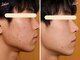 エピファニー(Epi phany Total Beauty Salon)の写真/【毛穴レスの陶器肌へ】ハイドロ水素で角質層から徹底ケア!黒ずみ・ザラつきを撃退し透明感溢れる素肌へ♪